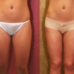 Liposuction Thighs Before & After Patient #9451