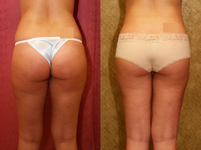 Liposuction Thighs Before & After Patient #9451