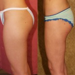 Liposuction Thighs Before & After Patient #9455