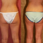 Liposuction Thighs Before & After Patient #9455