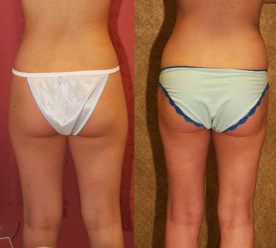 Liposuction Thighs Before & After Patient #9455