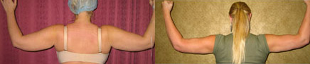 Liposuction Arms Before & After Patient #9460