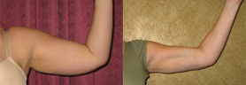 Liposuction Arms Before & After Patient #9460