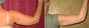Liposuction Arms Before & After Patient #9460