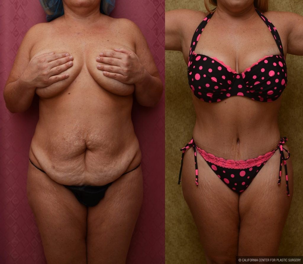 Tummy Tuck Medium Size Before & After Patient #9777