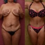 Tummy Tuck (Abdominoplasty) Medium Size Before & After Patient #9777