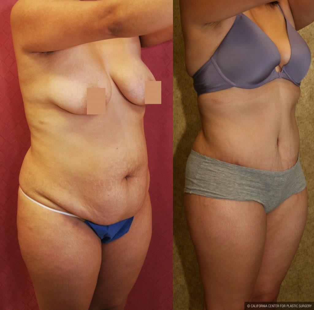 Tummy Tuck (Abdominoplasty) Medium Size Before & After Patient #9771