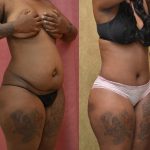 African American Tummy Tuck (Abdominoplasty) Before & After Patient #9787