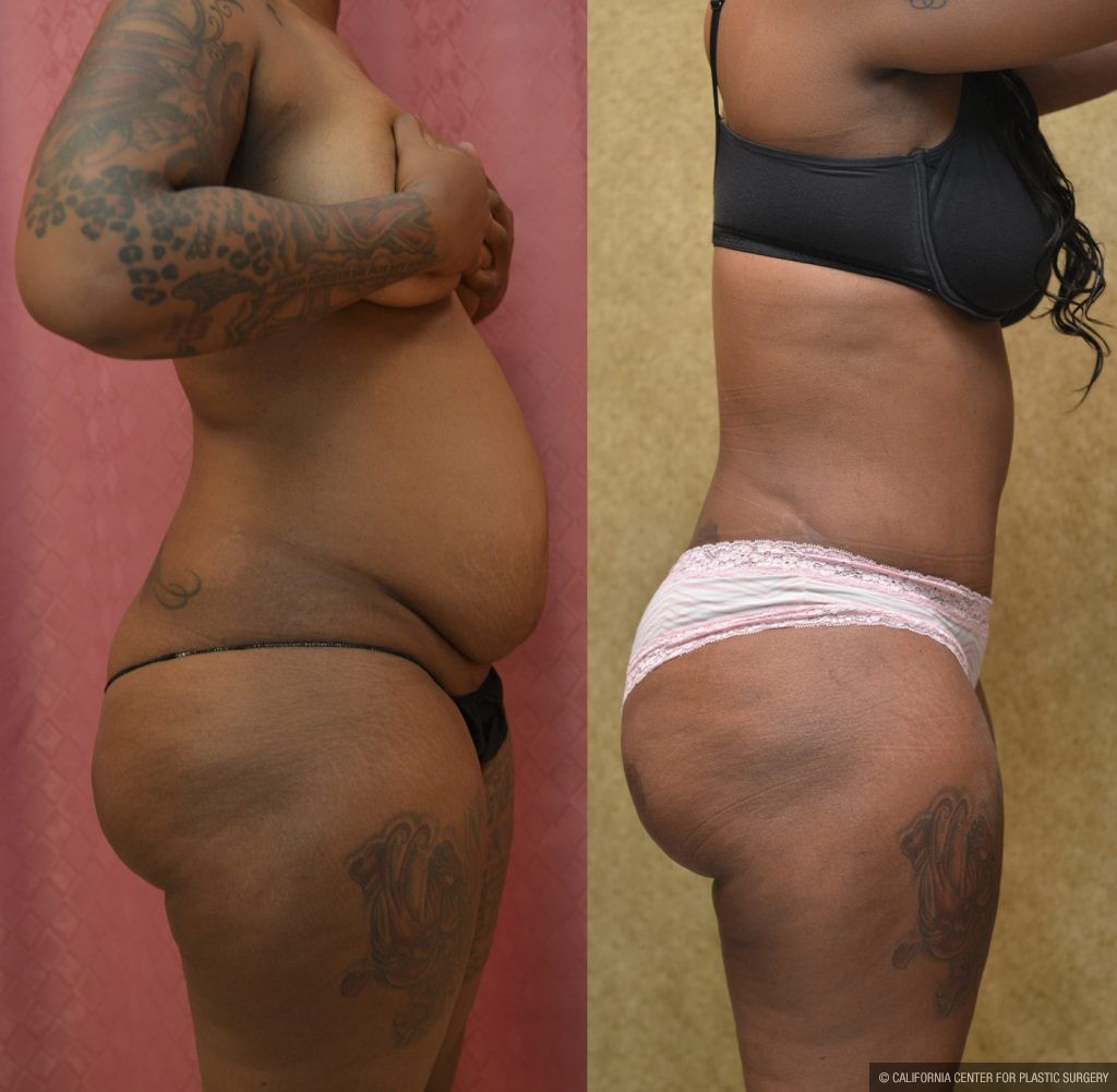 African American Tummy Tuck (Abdominoplasty) Before & After Patient #9787