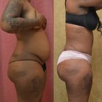 African American Tummy Tuck (Abdominoplasty) Before & After Patient #9787