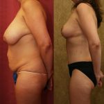Tummy Tuck (Abdominoplasty) Medium Size Before & After Patient #9783