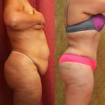 Tummy Tuck (Abdominoplasty) Plus Size Before & After Patient #9794