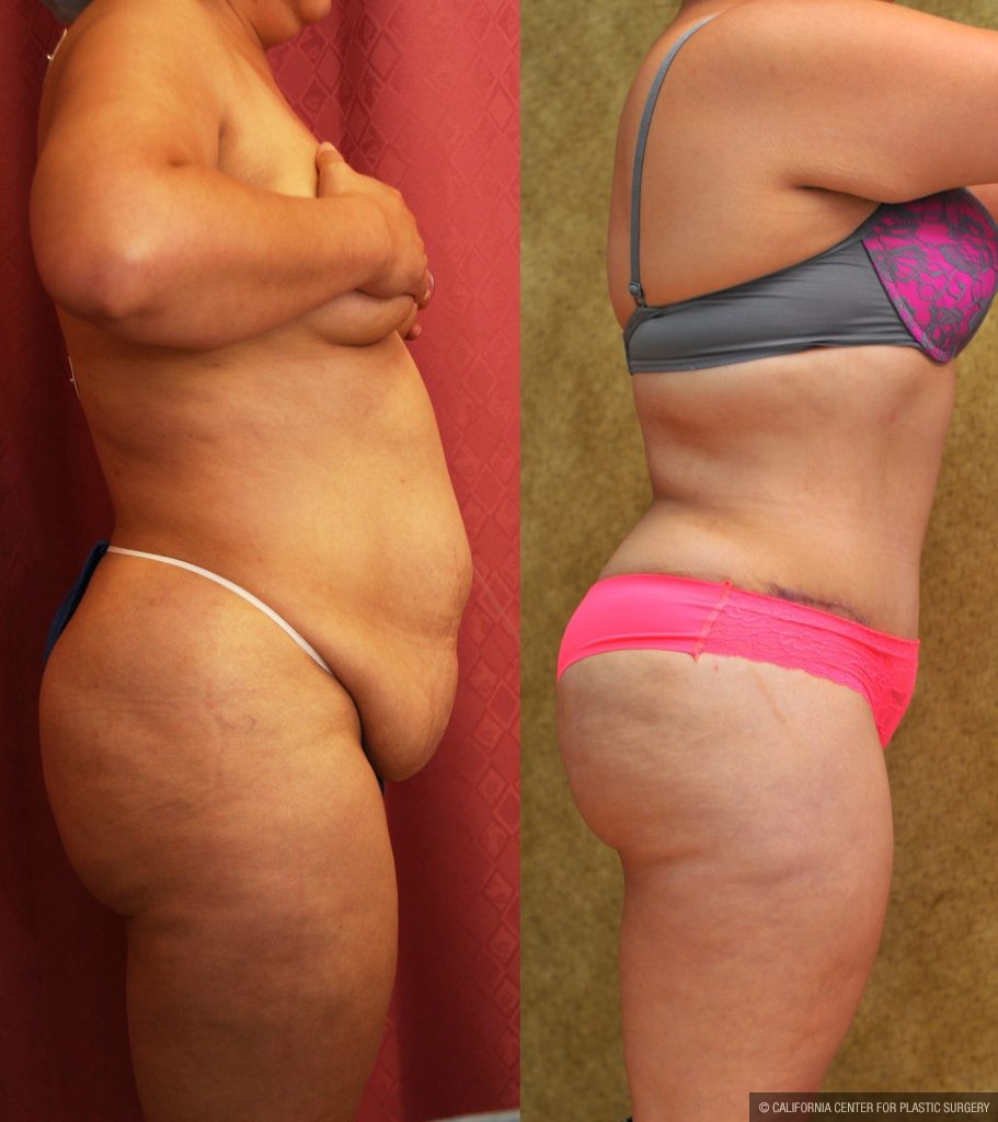 Tummy Tuck (Abdominoplasty) Plus Size Before & After Patient #9794