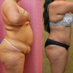 Tummy Tuck (Abdominoplasty) Plus Size Before & After Patient #9798