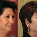 Eyelid (Blepharoplasty) Before & After Patient #9913