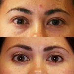 Asian Eyelid Surgery (Blepharoplasty) Before & After Patient #9888