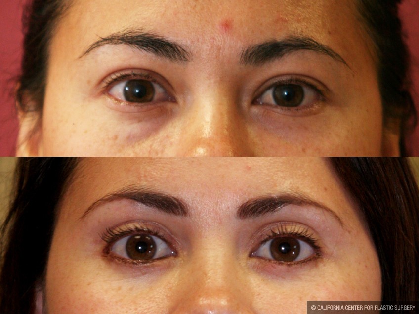 Asian Eyelid Surgery (Blepharoplasty) Before & After Patient #9888