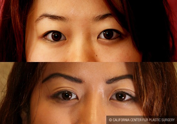 Asian Eyelid Surgery (Blepharoplasty) Before & After Patient #9883