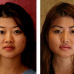 Asian Eyelid Surgery (Blepharoplasty) Before & After Patient #9883