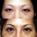 Asian Eyelid Surgery (Blepharoplasty) Before & After Patient #9886