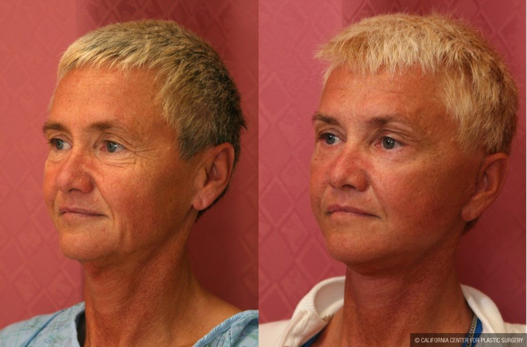 Eyelid (Blepharoplasty) Before & After Patient #9876