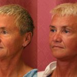 Eyelid (Blepharoplasty) Before & After Patient #9876