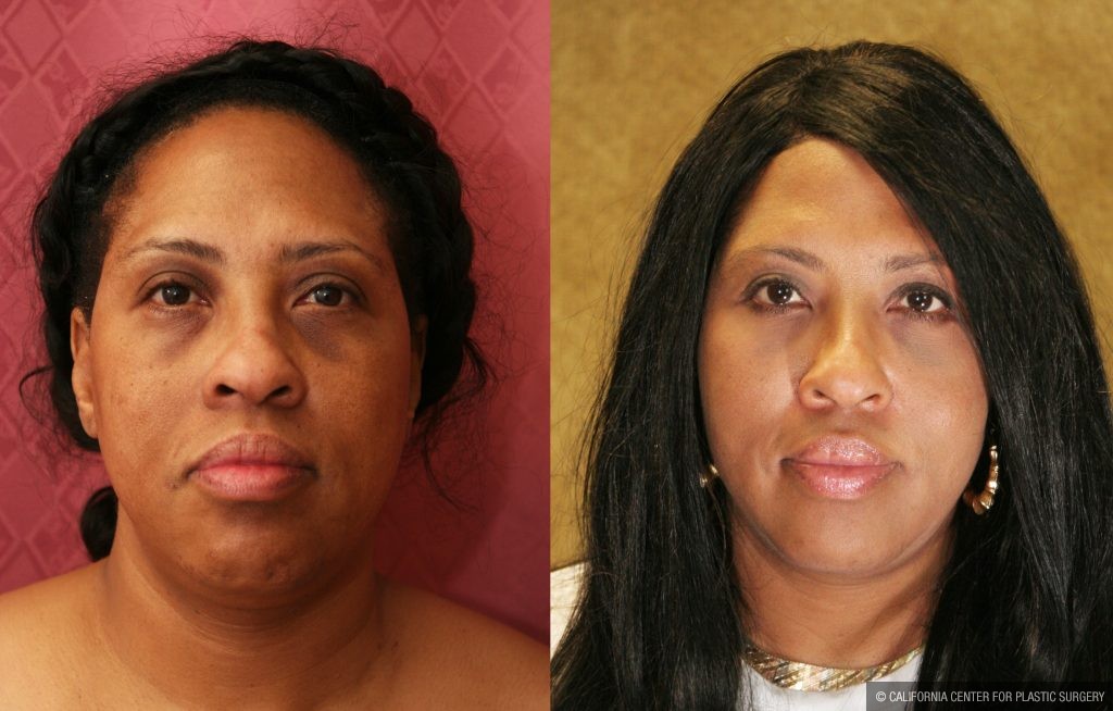 Eyelid (Blepharoplasty) Before & After Patient #9908