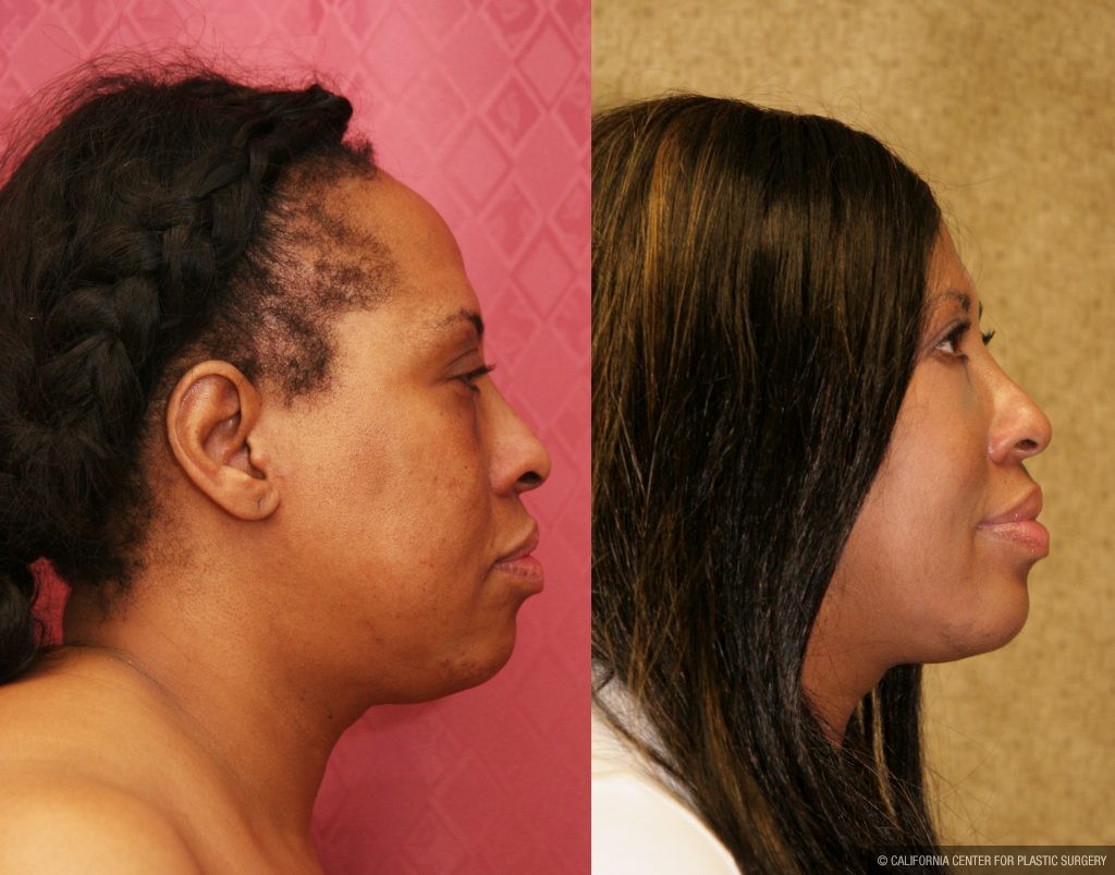 Eyelid (Blepharoplasty) Before & After Patient #9908