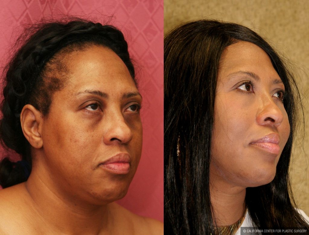 Eyelid (Blepharoplasty) Before & After Patient #9908