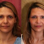 Eyelid (Blepharoplasty) Before & After Patient #9859