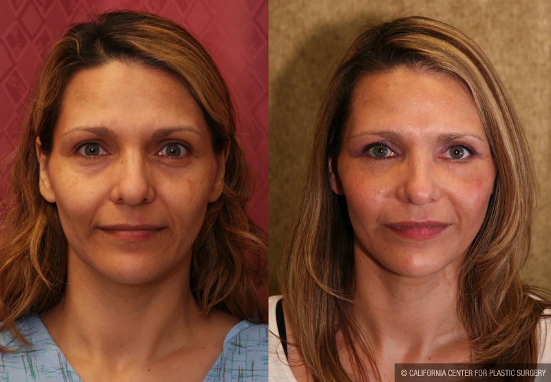 Eyelid (Blepharoplasty) Before & After Patient #9859