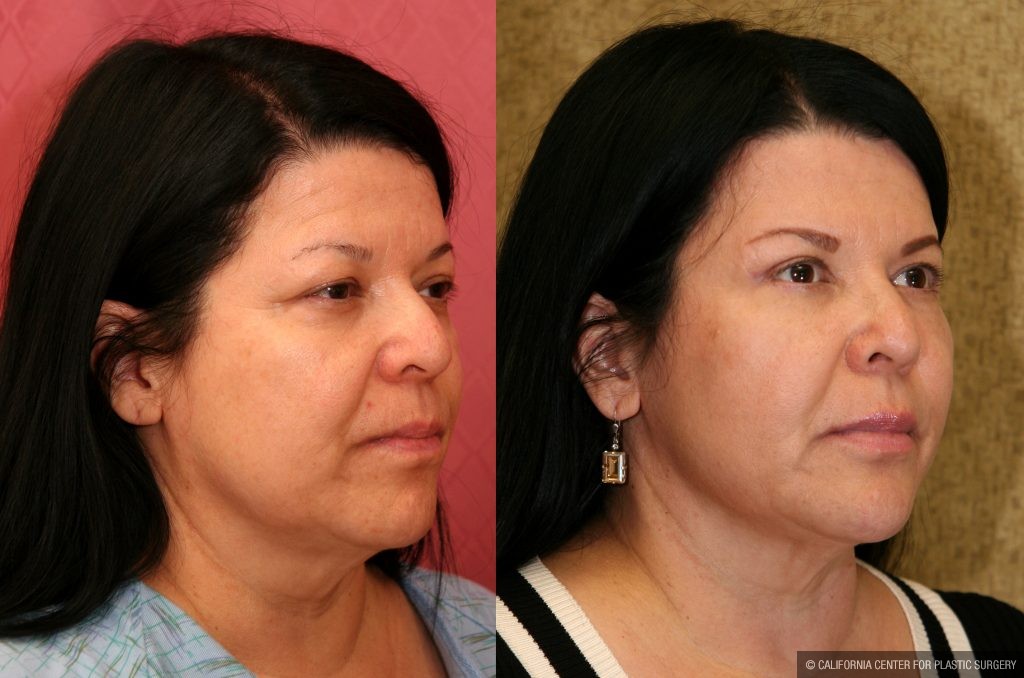 Eyelid (Blepharoplasty) Before & After Patient #9902