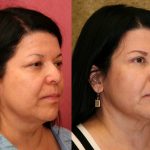 Eyelid (Blepharoplasty) Before & After Patient #9902