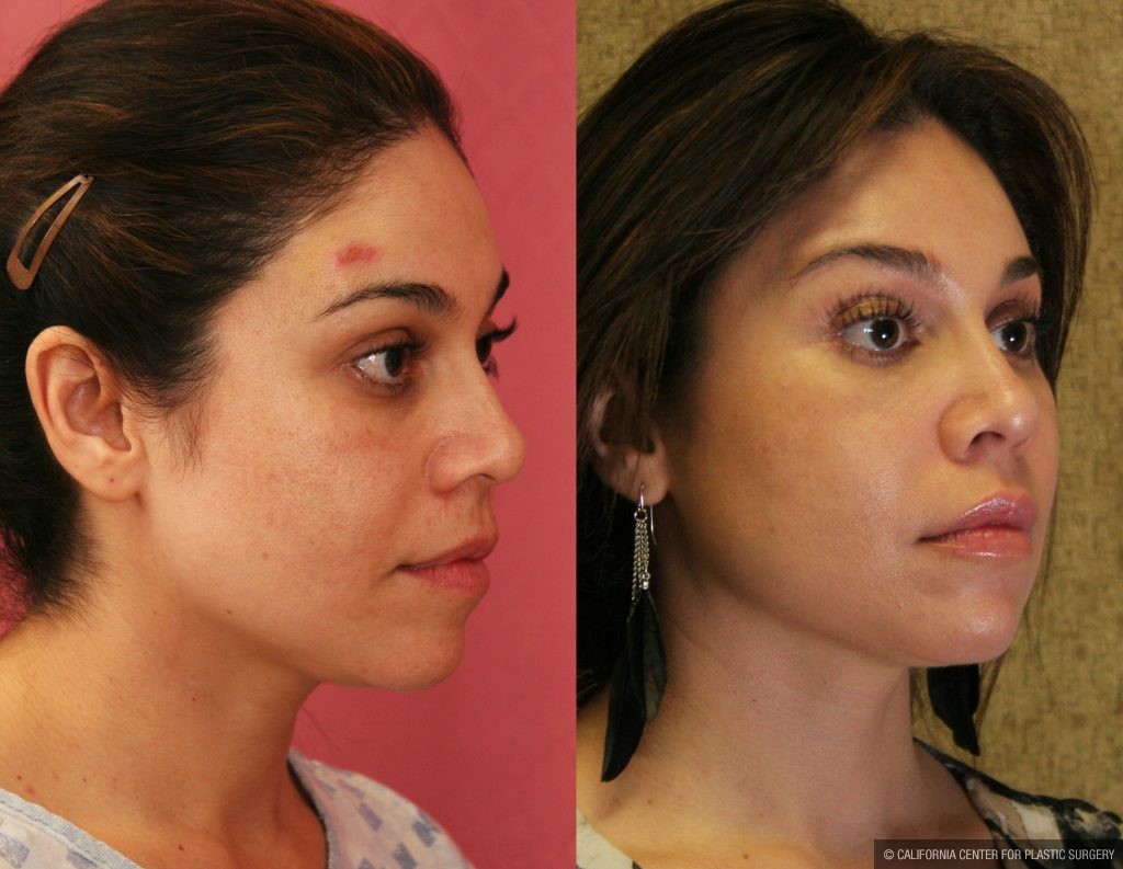 Eyelid (Blepharoplasty) Before & After Patient #9865