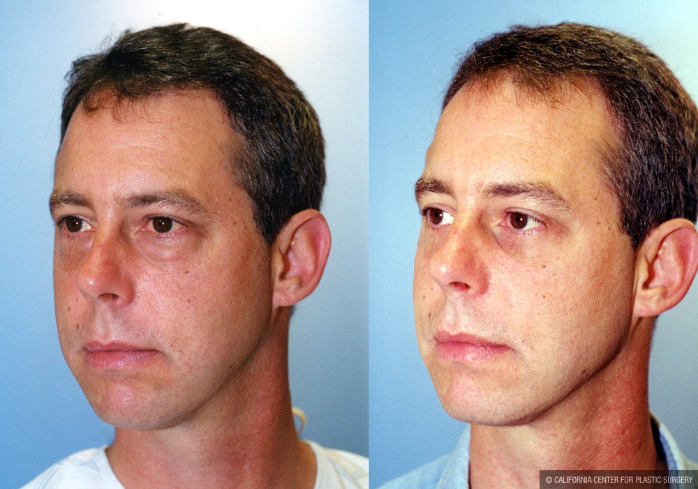 Eyelid (Blepharoplasty) Before & After Patient #9927