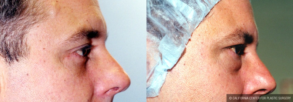 Eyelid (Blepharoplasty) Before & After Patient #9927