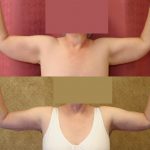 Arm Lift (Brachioplasty) Before & After Patient #9961