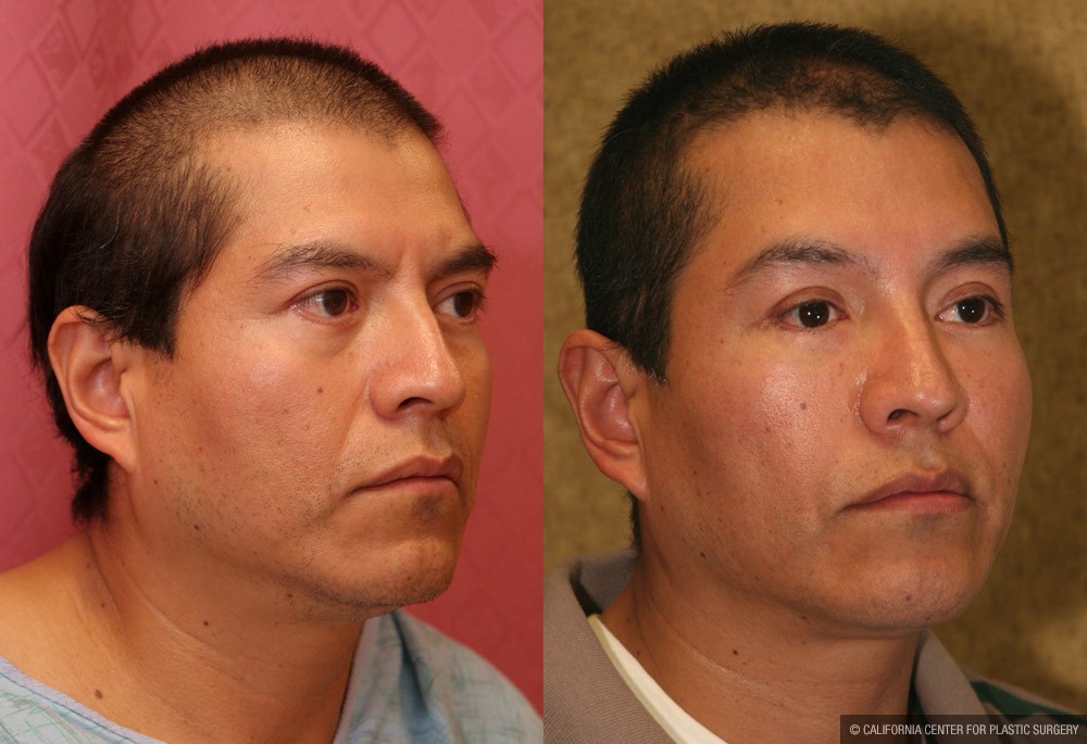 Eyelid (Blepharoplasty) Before & After Patient #9936