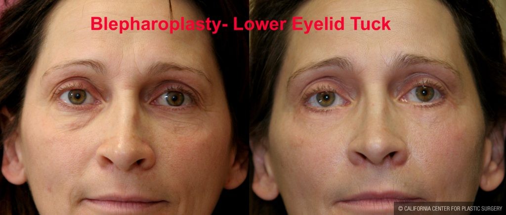 Eyelid (Blepharoplasty) Before & After Patient #9871