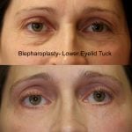 Eyelid (Blepharoplasty) Before & After Patient #9871