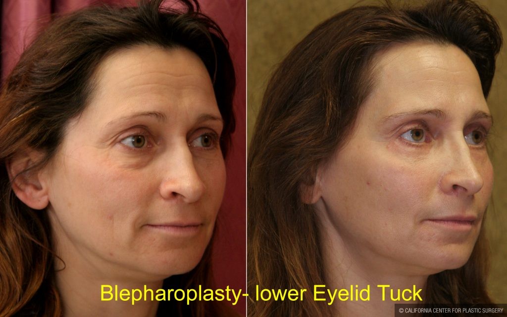 Eyelid (Blepharoplasty) Before & After Patient #9871