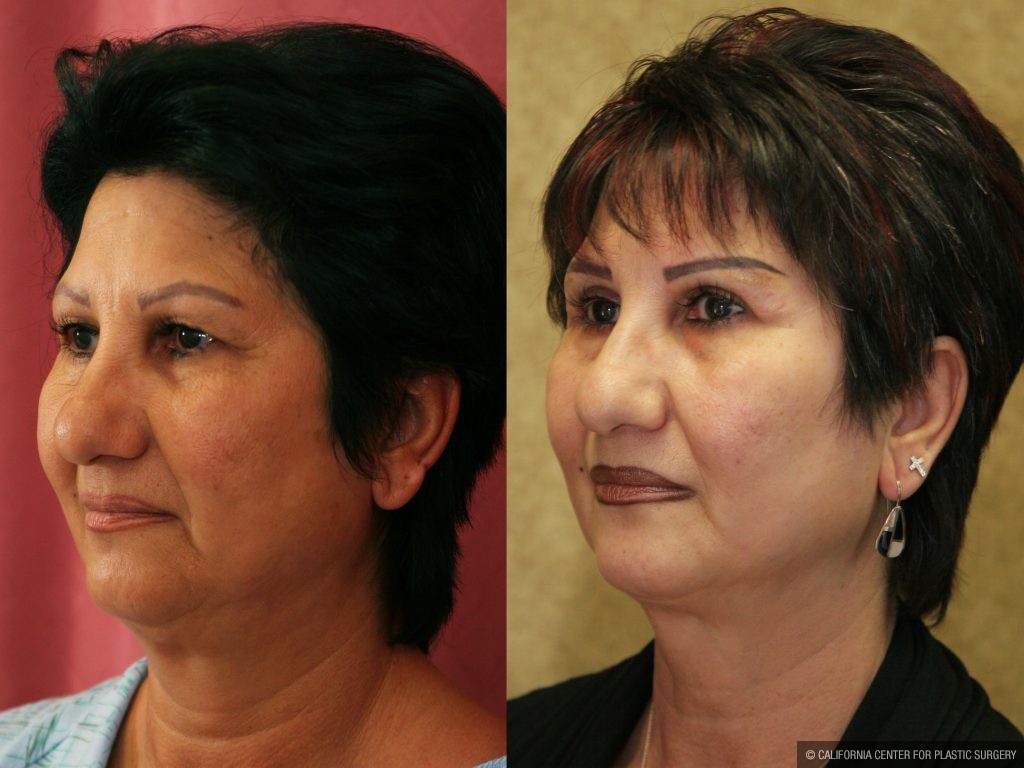 Eyelid (Blepharoplasty) Before & After Patient #9913