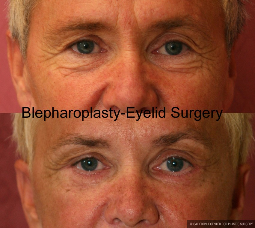 Eyelid (Blepharoplasty) Before & After Patient #9876