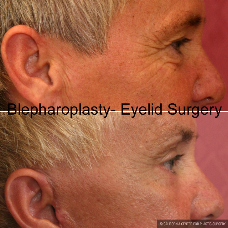 Eyelid (Blepharoplasty) Before & After Patient #9876