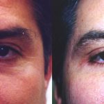 Eyelid (Blepharoplasty) Before & After Patient #9942