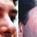 Eyelid (Blepharoplasty) Before & After Patient #9942