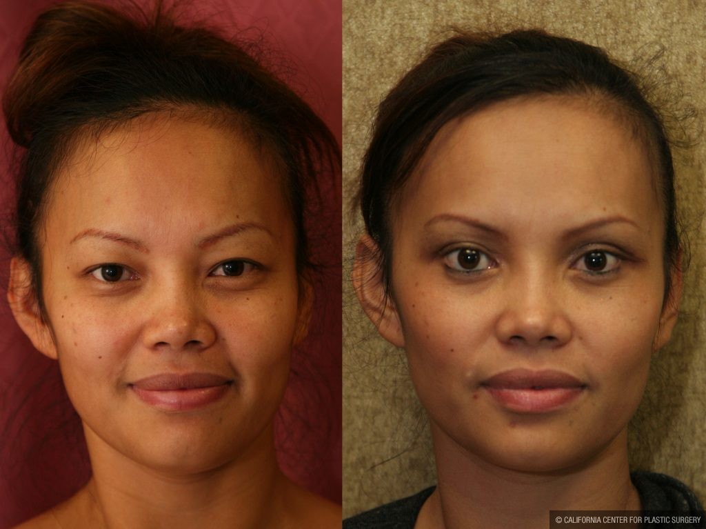 Asian Plastic Surgery Before After 109