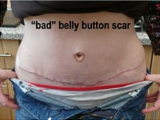 Best Tummy Tuck Belly Button Scar Encino & Bakersfield