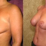 Breast Augmentation Before & After Patient #10429