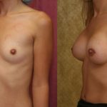Breast Augmentation Before & After Patient #10426